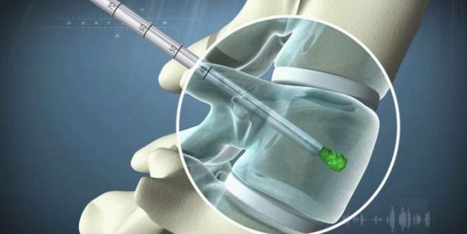 医疗器械三维动画制作效果图 医疗器械三维动画制作效果图