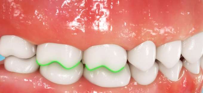 牙齿矫正三维动画制作 牙齿矫正三维动画制作